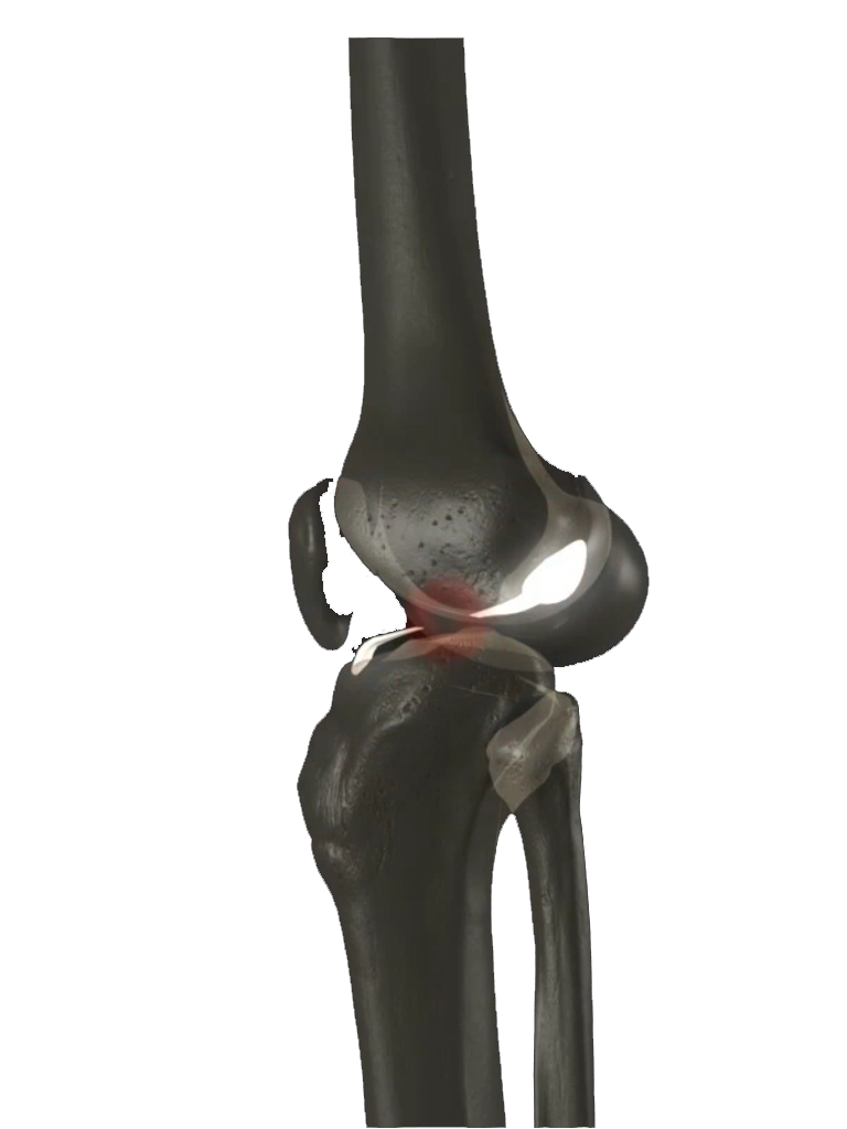 Ligamento Cruzado Anterior