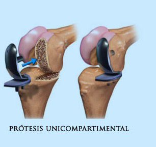 Pr�tesis Unicompartimental